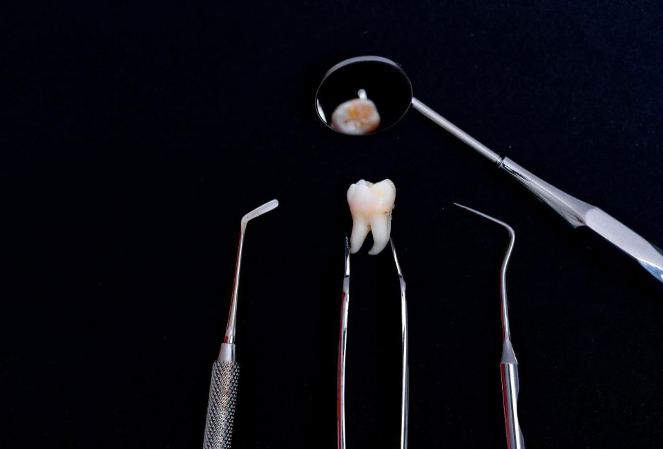 The Procedure, Pros, and Cons of Wisdom Teeth Removal A Quick Guide