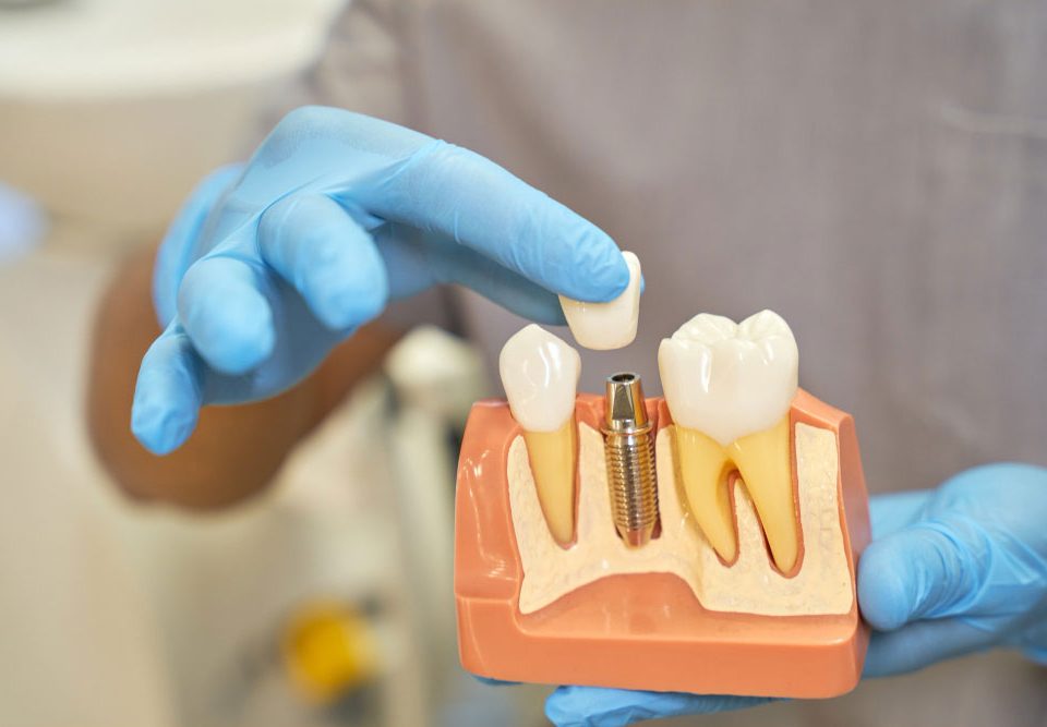 A Comprehensive Guide to Digital Impressions in Dental Implants
