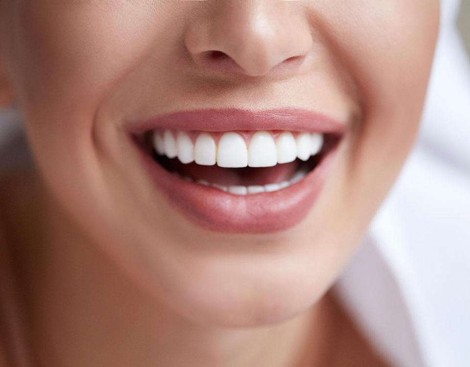 How Long Does Teeth Whitening Last