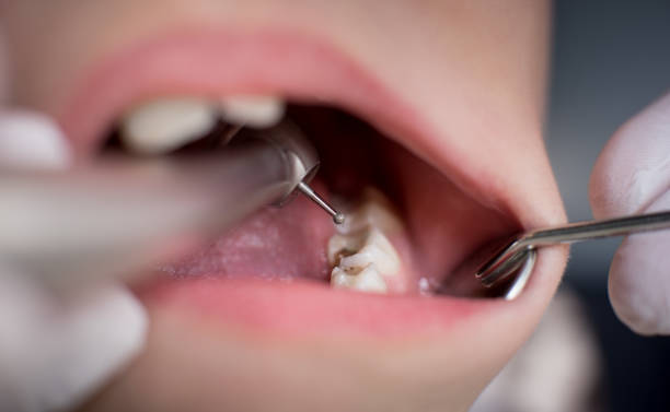 Cavity Fillings