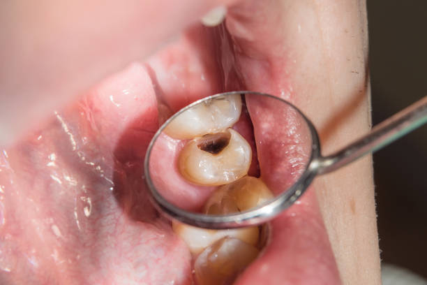 Why Are Cavities the Most Common Dental Problem in Sutherland Shire?